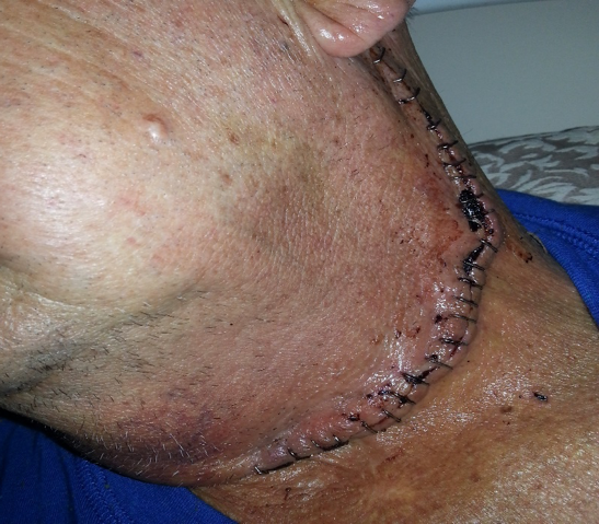 SidAfterNeckSurgery.png
